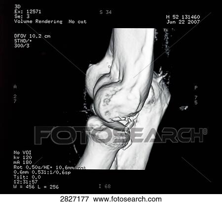 Close-up of x-ray image of human bones View Large Photo Image Stock Photo - Close-up of x-ray image of human bones . Fotosearch