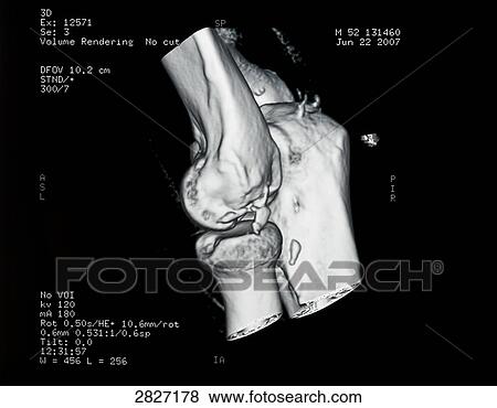 Close-up of x-ray image of human bones View Large Photo Image Stock Photo - Close-up of x-ray image of human bones . Fotosearch
