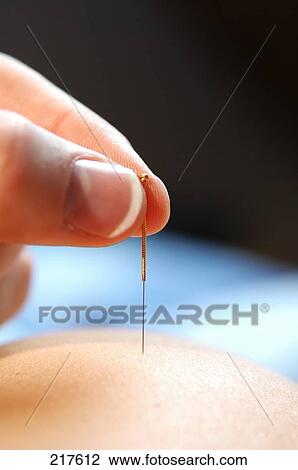 Close-up of person's hand inserting acupuncture needle on another person's skin View Large Photo Image Stock Image - Close-up of person's hand inserting acupuncture needle on another person's skin . Fotosearch