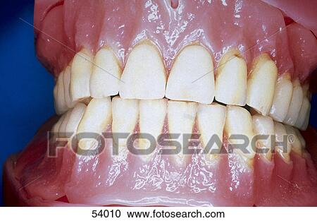 Close-up of dentures View Large Photo Image Stock Image - Close-up of dentures . Fotosearch