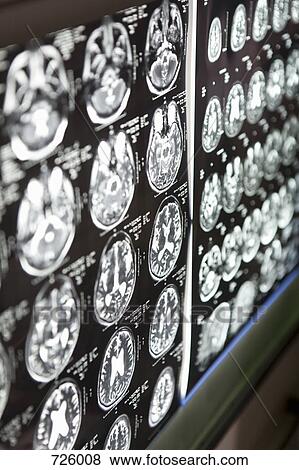 Stock Photo - Brain scans on a light box. Fotosearch