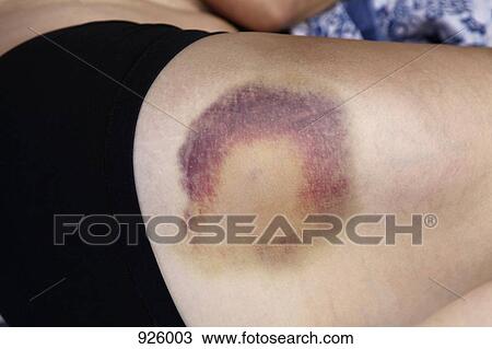 Detail of a bruise on the thigh of a woman View Large Photo Image Stock Image - Detail of a bruise on the thigh of a woman. Fotosearch