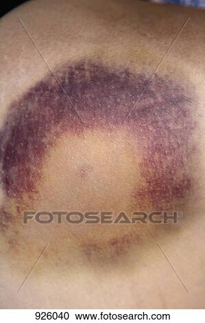 Stock Image - Detail of a bruise on the thigh of a woman. Fotosearch