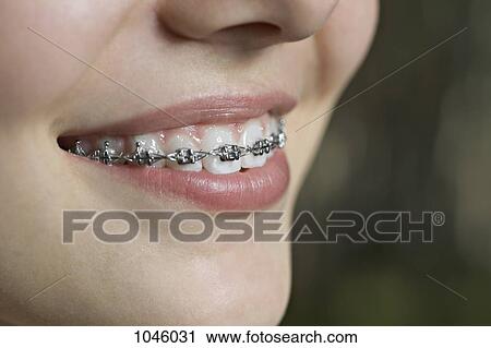 A smiling teenager with dental braces, ECU View Large Photo Image Stock Image - A smiling teenager with dental braces, ECU. Fotosearch