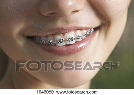 A smiling teenager with dental braces, ECU View Large Photo Image Stock Image - A smiling teenager with dental braces, ECU. Fotosearch