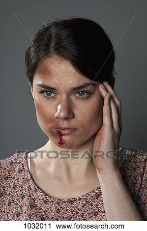 Stock Image - A woman with bruises and bloody lip. Fotosearch