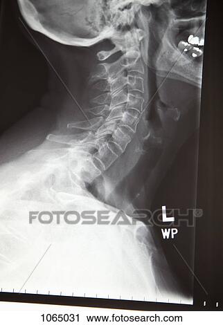 Stock Image - Close-up of an x-ray of a human neck. Fotosearch