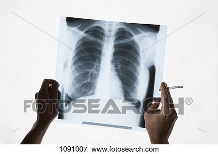 Hands holding a chest x-ray and a cigarette, close-up View Large Photo Image Stock Photo - Hands holding a chest x-ray and a cigarette, close-up. Fotosearch