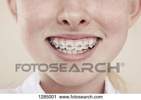 Stock Image - A smiling girl with braces on her teeth, close-up of mouth. Fotosearch