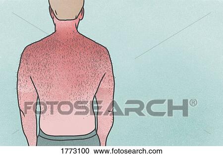 Man with hairy, sunburned back View Large Photo Image Stock Image - Man with hairy, sunburned back. Fotosearch