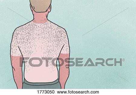 Sunburned man with hairy back on blue background View Large Photo Image Stock Image - Sunburned man with hairy back on blue background. Fotosearch