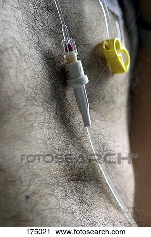 An intravenous drip across a man's chest View Large Photo Image Stock Image - An intravenous drip across a man's chest. Fotosearch