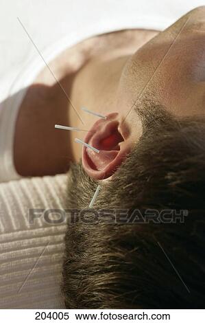 Stock Photography - Close-up of man receiving acupuncture on ear. Fotosearch