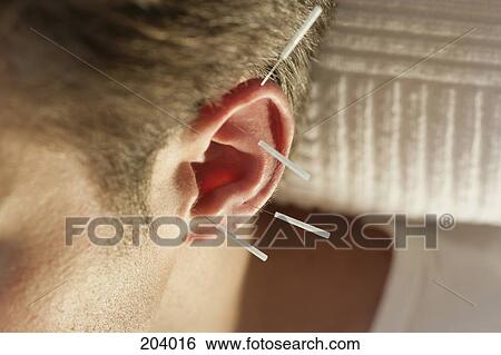 Close-up of man with acupuncture needles on ear View Large Photo Image Stock Photograph - Close-up of man with acupuncture needles on ear. Fotosearch