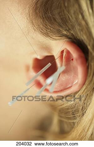 Close-up of woman receiving acupuncture on ear View Large Photo Image Stock Image - Close-up of woman receiving acupuncture on ear. Fotosearch