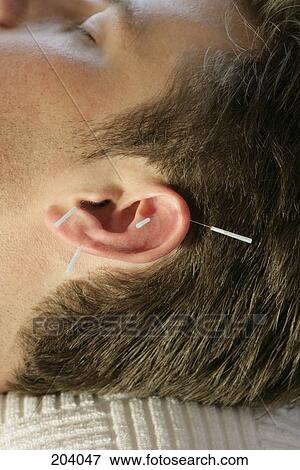 Man receiving acupuncture on ear View Large Photo Image Stock Photo - Man receiving acupuncture on ear. Fotosearch