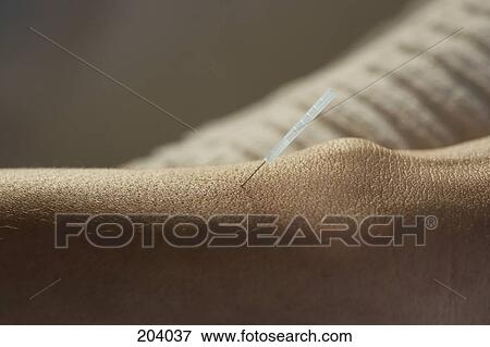 Young woman receiving acupuncture on wrist View Large Photo Image Stock Photo - Young woman receiving acupuncture on wrist. Fotosearch