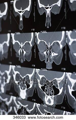 CAT scan of a person’s head View Large Photo Image Stock Image - CAT scan of a person’s head. Fotosearch