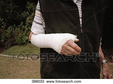 Stock Image - Elderly man with her arm in a plaster cast. Fotosearch