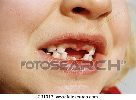 Close-up of a young girl with missing teeth View Large Photo Image Stock Image - Close-up of a young girl with missing teeth. Fotosearch