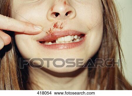 Picture - Young girl with a scratched face. Fotosearch