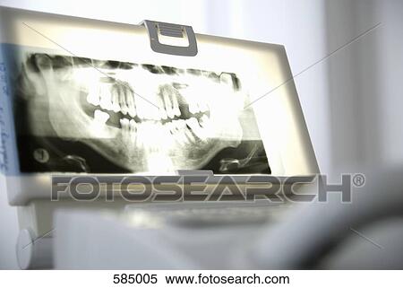 Dental X-ray on a light box View Large Photo Image Stock Photography - Dental X-ray on a light box. Fotosearch