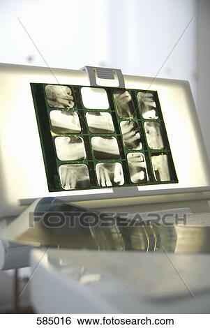 Lightbox with Dental X-ray View Large Photo Image Stock Photograph - Lightbox with Dental X-ray. Fotosearch