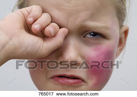 A little girl with a bruise on her cheek crying View Large Photo Image Stock Photo - A little girl with a bruise on her cheek crying. Fotosearch