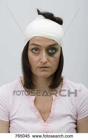 A woman with a black eye and bandaged head View Large Photo Image Stock Photography - A woman with a black eye and bandaged head. Fotosearch