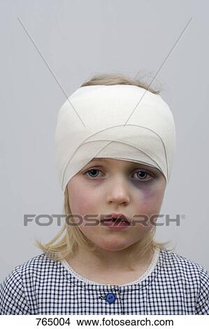 Picture - A young girl with a black eye and bandaged head. Fotosearch
