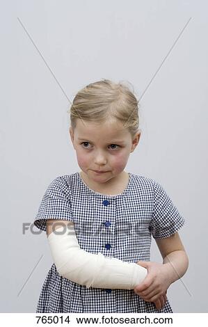 Picture - A young girl with a broken arm. Fotosearch