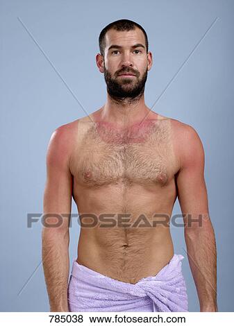 A sunburnt man View Large Photo Image Stock Photo - A sunburnt man. Fotosearch