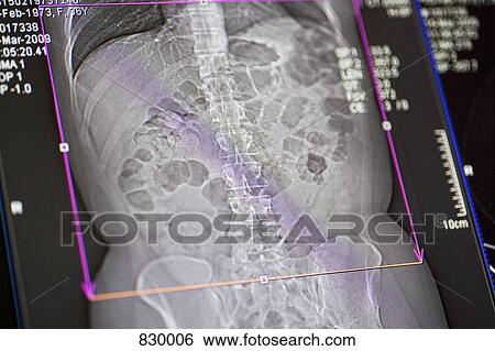 CAT Scan of a midsection of a person View Large Photo Image Stock Photograph - CAT Scan of a midsection of a person. Fotosearch