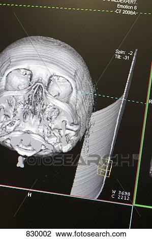 Stock Image - CAT scan of a skull. Fotosearch