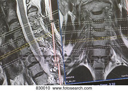 CAT Scan of the spine View Large Photo Image Stock Image - CAT Scan of the spine. Fotosearch