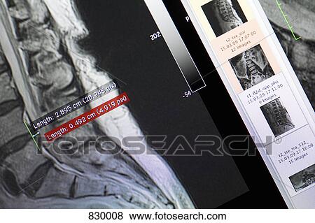 CAT Scan of the spine View Large Photo Image Stock Photo - CAT Scan of the spine. Fotosearch