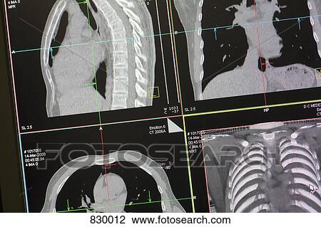CAT Scan View Large Photo Image Stock Image - CAT Scan. Fotosearch