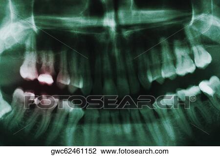 Close-up of a dental X-Ray View Large Photo Image Stock Image - Close-up of a dental X-Ray. Fotosearch