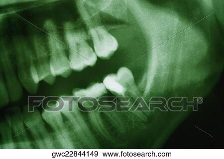 Close-up of a dental X-Ray View Large Photo Image Stock Photo - Close-up of a dental X-Ray. Fotosearch