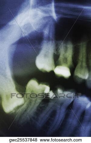 Close-up of a dental X-Ray View Large Photo Image Stock Photo - Close-up of a dental X-Ray. Fotosearch