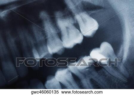Close-up of a dental X-Ray View Large Photo Image Stock Photography - Close-up of a dental X-Ray. Fotosearch
