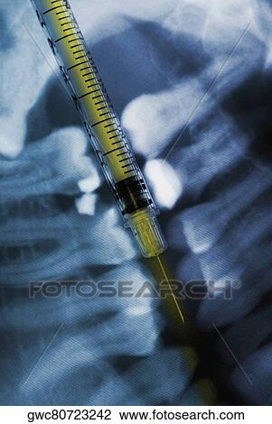 Close-up of a syringe and a dental X-Ray View Large Photo Image Stock Image - Close-up of a syringe and a dental X-Ray. Fotosearch