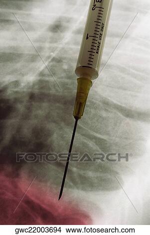 Close-up of a syringe on an X-Ray View Large Photo Image Picture - Close-up of a syringe on an X-Ray. Fotosearch