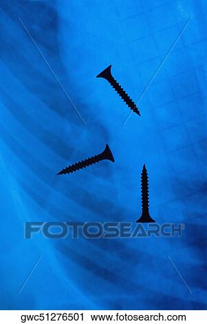 Three screws shown in an X-ray report View Large Photo Image Stock Image - Three screws shown in an X-ray report. Fotosearch