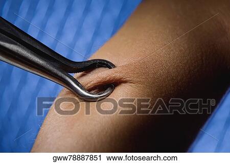 Surgical tongs gripping a persons arm View Large Photo Image Stock Image - Surgical tongs gripping a persons arm. Fotosearch