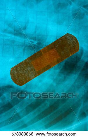 Stock Photograph - Close-up of a bandage on an X-Ray. Fotosearch