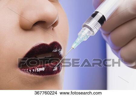 Picture - Close-up of a surgeon's hand injecting on lips of a young woman. Fotosearch