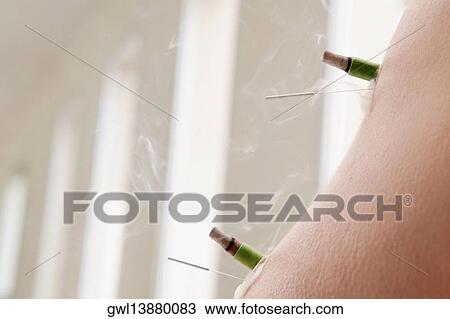 Acupuncture needles and herbal cigars on a person's arm View Large Photo Image Stock Image - Acupuncture needles and herbal cigars on a person's arm. Fotosearch