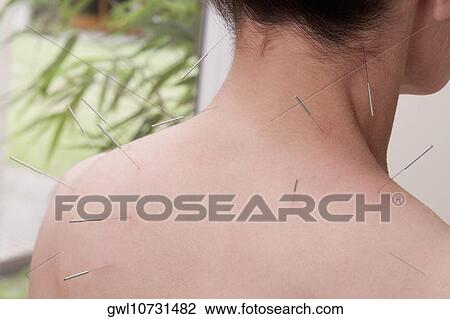 Acupuncture needles on a person's back View Large Photo Image Stock Image - Acupuncture needles on a person's back. Fotosearch