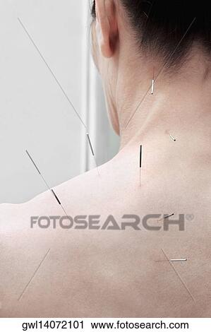 Acupuncture needles on a person's back View Large Photo Image Stock Image - Acupuncture needles on a person's back. Fotosearch